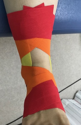 衝突性外骨腫に対するテーピング