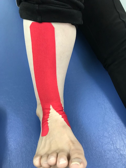 足関節後方インピンジメント症候群に対するテーピング