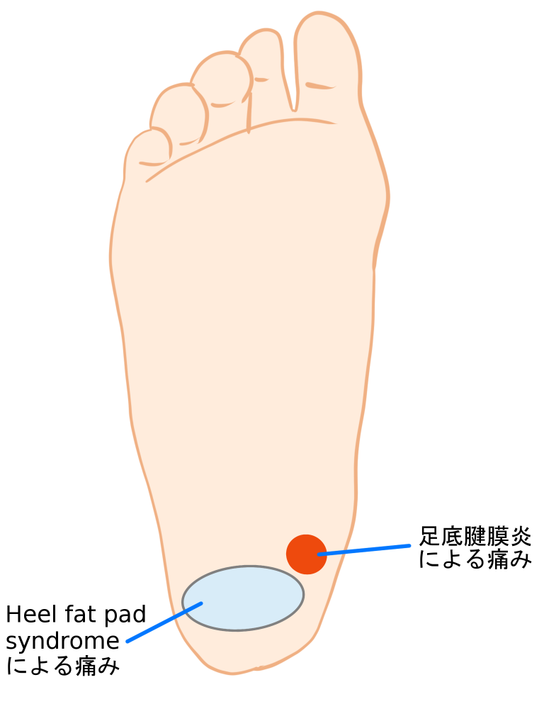 有痛性踵パッドについて 金沢市アルコット接骨院 石川県金沢市 アルコット接骨院 スポーツ障害 巻き爪 インソール むち打ち