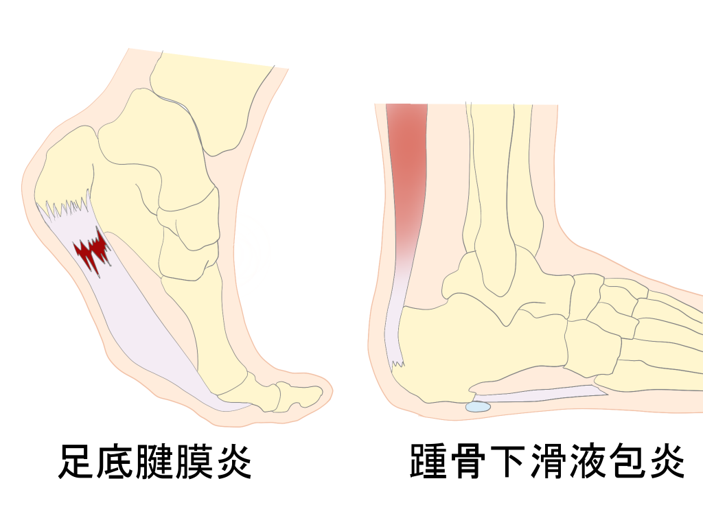 足底腱膜炎と踵骨下滑液包炎の違い