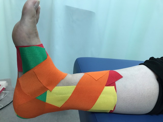 衝突性外骨腫に対するテーピング
