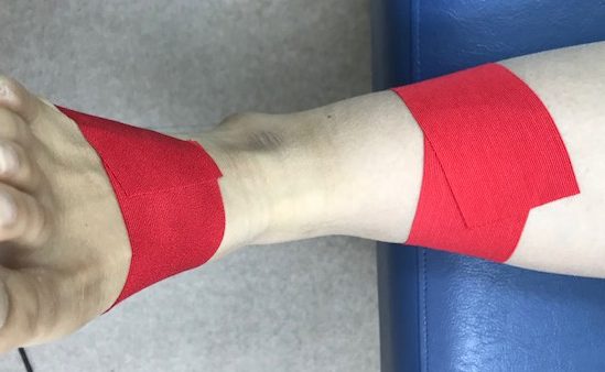 衝突性外骨腫に対するテーピング