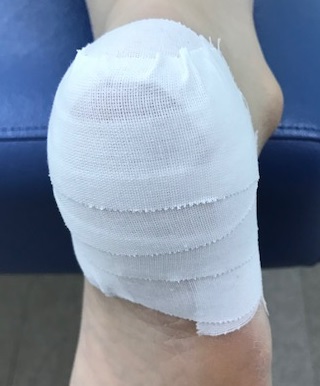 有痛性踵パッドテーピング