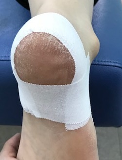 有痛性踵パッドテーピング