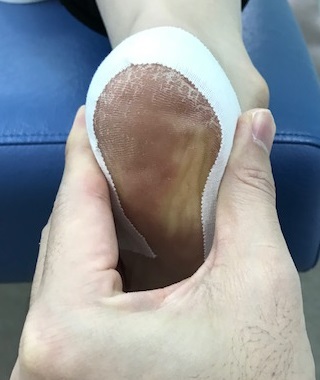 有痛性踵パッドテーピング