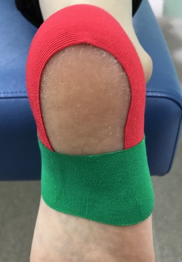 有痛性踵パッドテーピング色付き