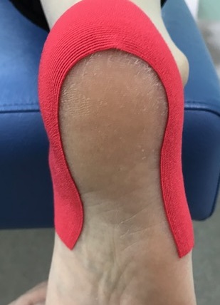 有痛性踵パッドテーピング色付き