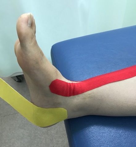 足関節後方インピンジメント症候群に対するテーピング