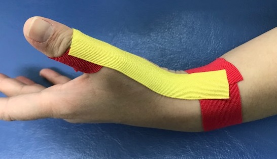 ドケルバン病テーピング
