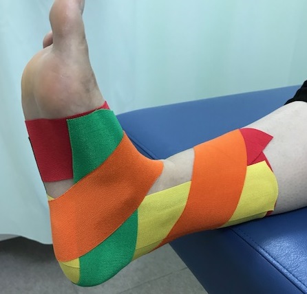 衝突性外骨腫に対するテーピング