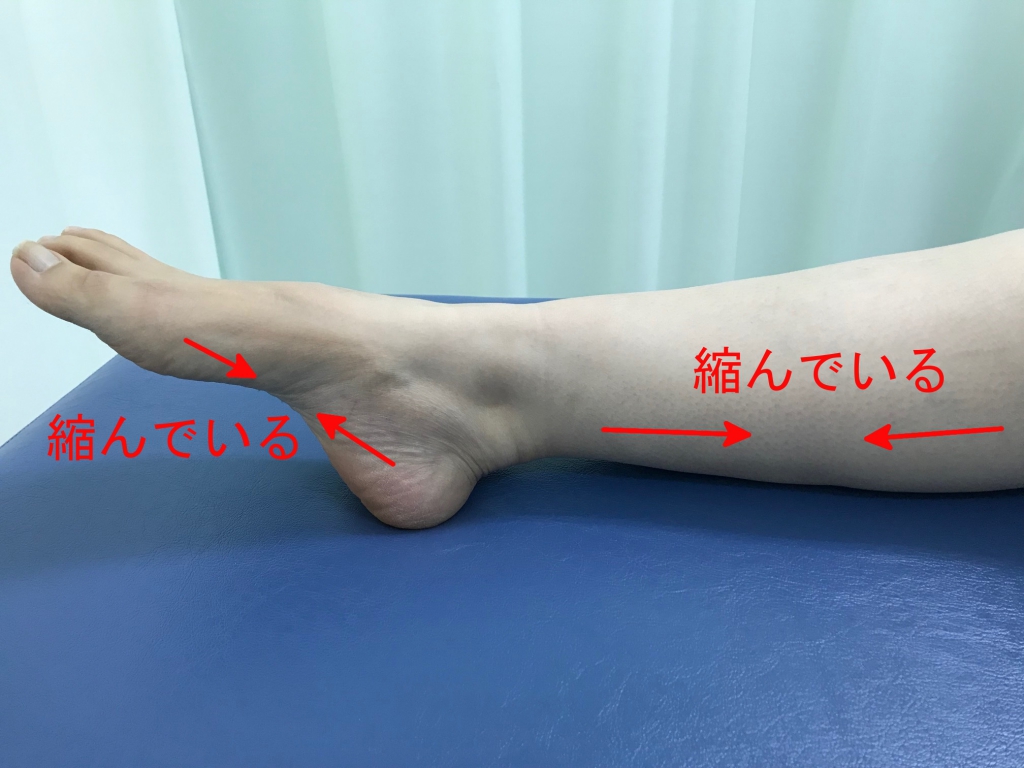 足底腱膜炎夜間の足の肢位