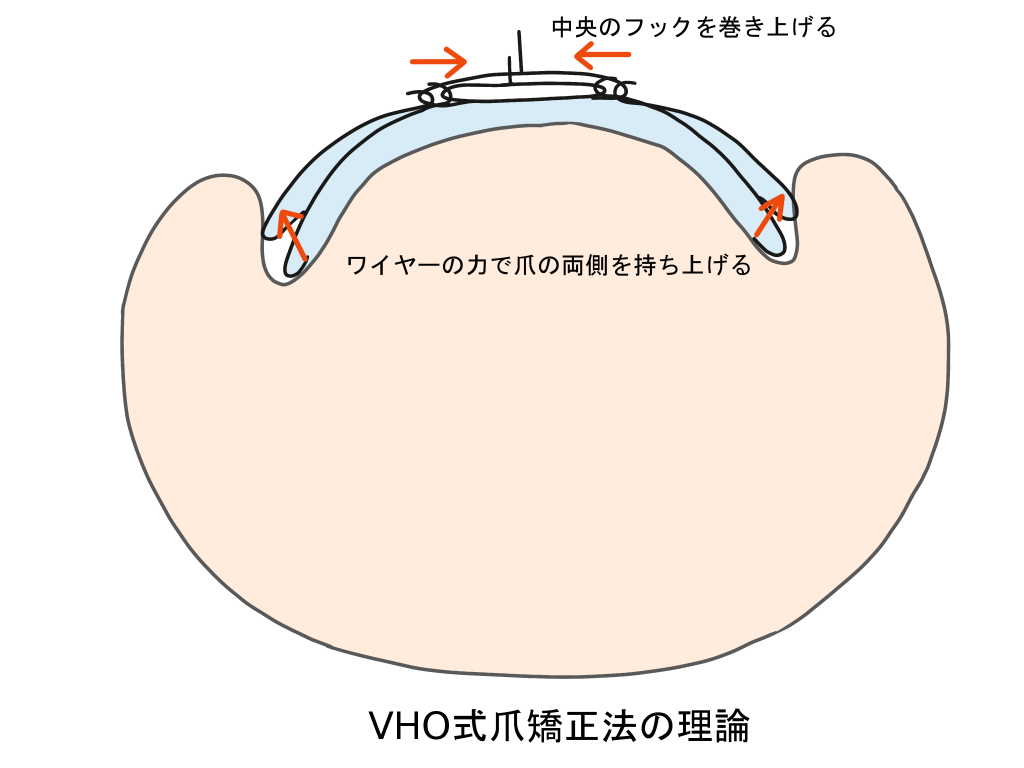 巻き爪治療VHO式爪矯正法