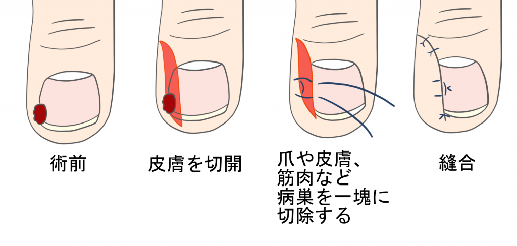 巻き爪の手術(鬼塚法)