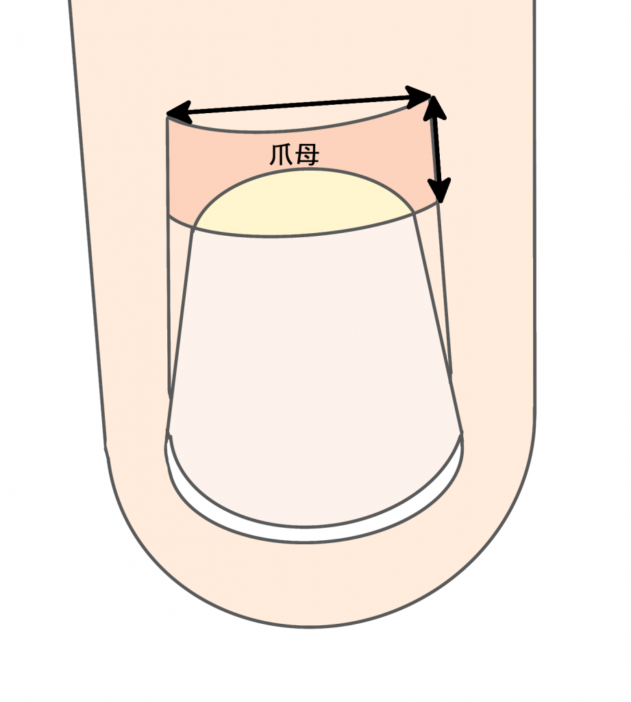 巻き爪治療(爪母の範囲)