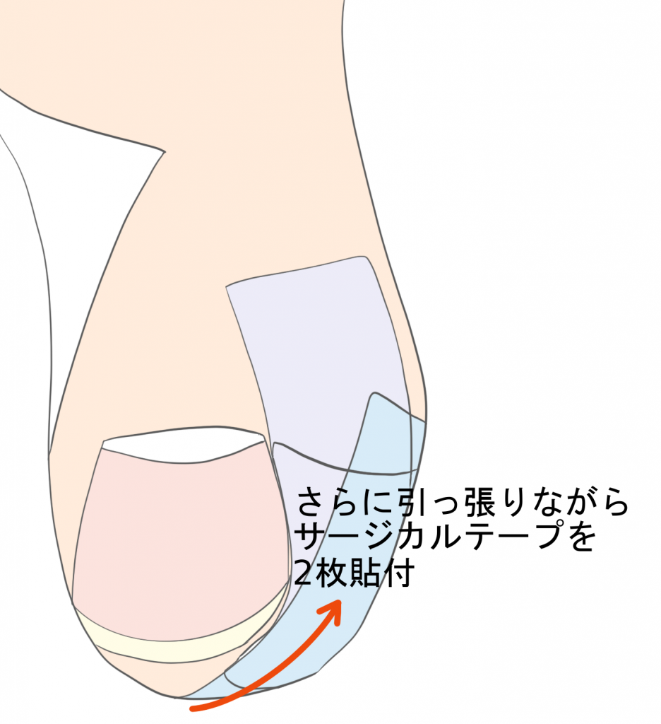 巻き爪治療テーピング法2