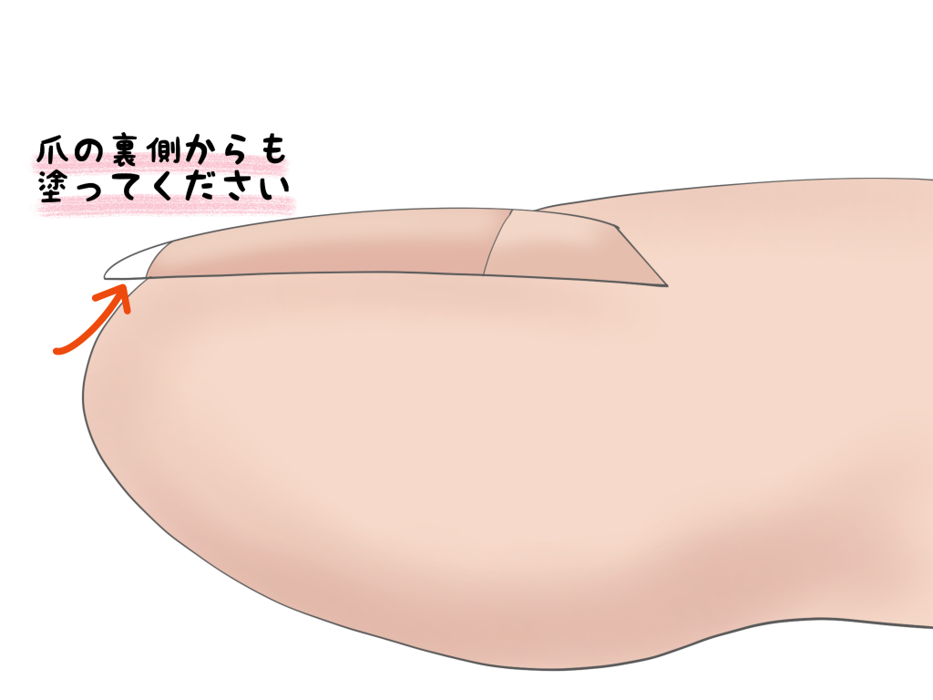 巻き爪予防(保湿)