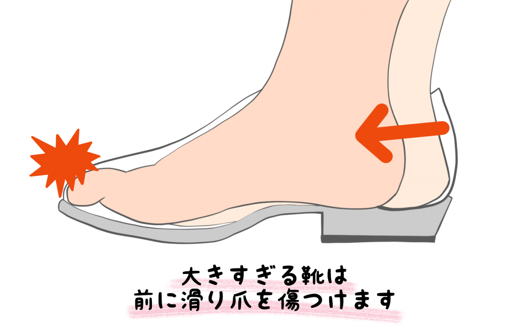 巻き爪の原因【金沢市のアルコット接骨院の巻き爪補正】