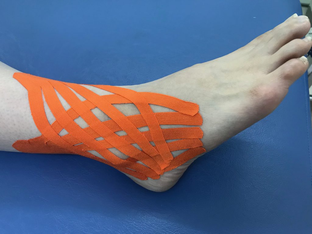 腓骨筋腱炎(急性期)テーピング