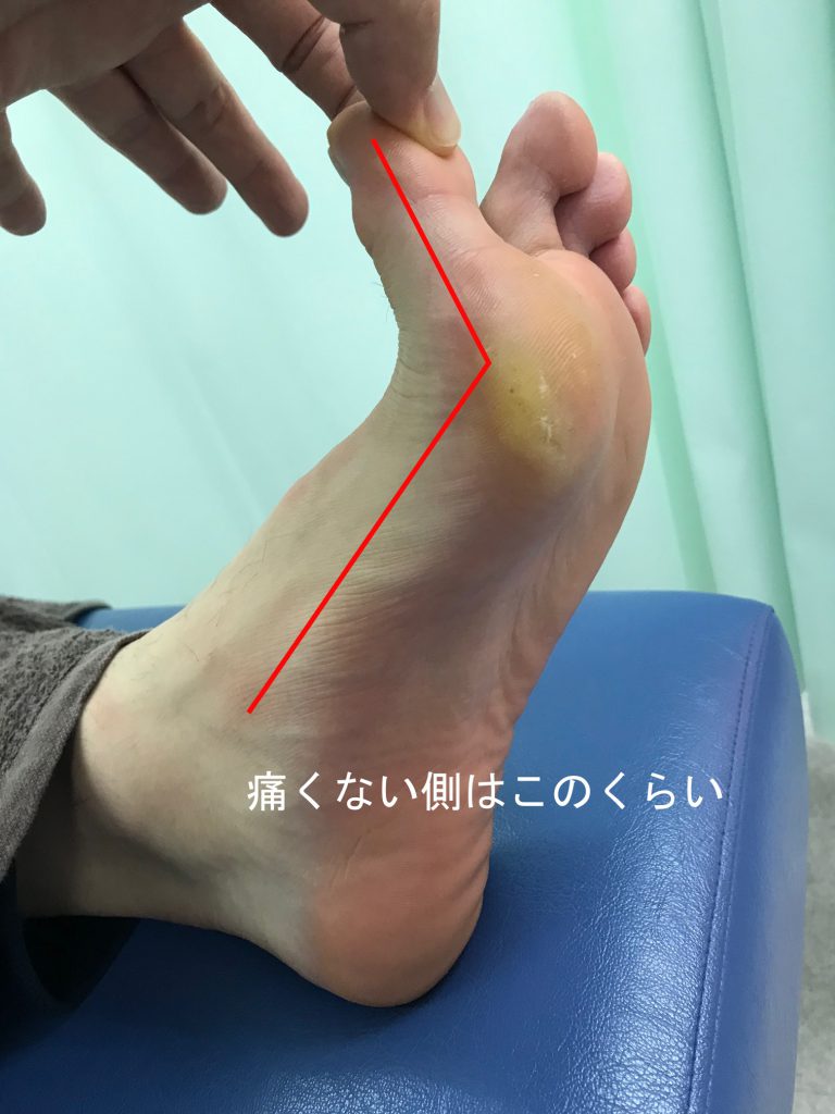 種子骨障害のテーピング法【金沢市のアルコット接骨院の疾患解説(足の裏の痛み)】