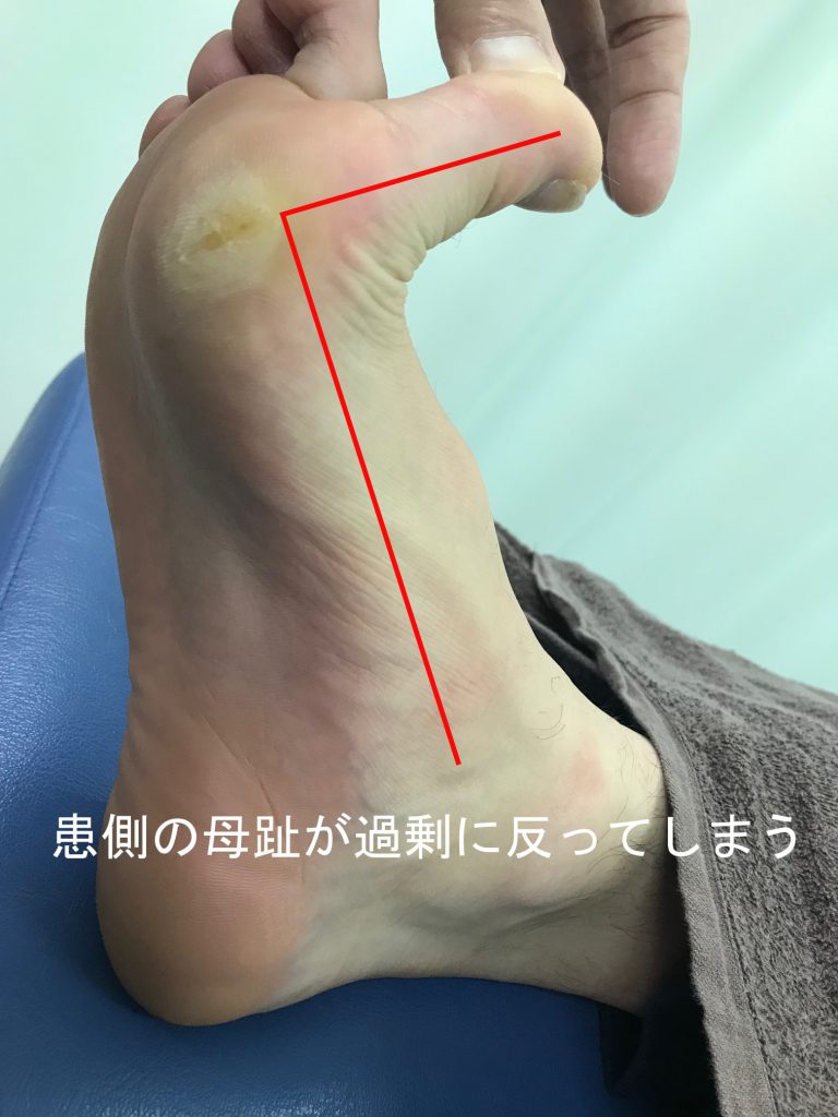 種子骨障害のテーピング法【金沢市のアルコット接骨院の疾患解説(足の裏の痛み)】