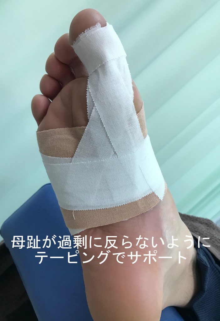 種子骨障害のテーピング法【金沢市のアルコット接骨院の疾患解説(足の裏の痛み)】