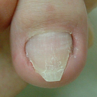 【金沢巻き爪】深爪（陥入爪）の原因と対処法　爪を切りすぎて痛いときはどうすればいい？【よくある質問】
