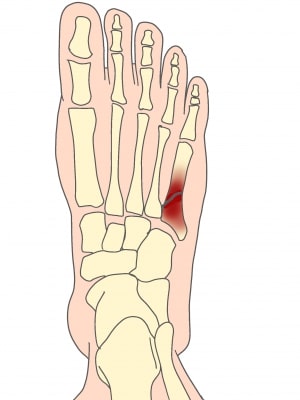 ジョーンズ骨折とは