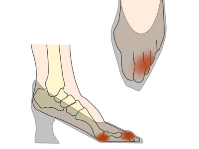 足趾の変形とパンプスの関係