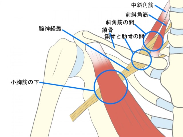 胸郭出口症候群圧迫型の神経の絞扼されるポイント