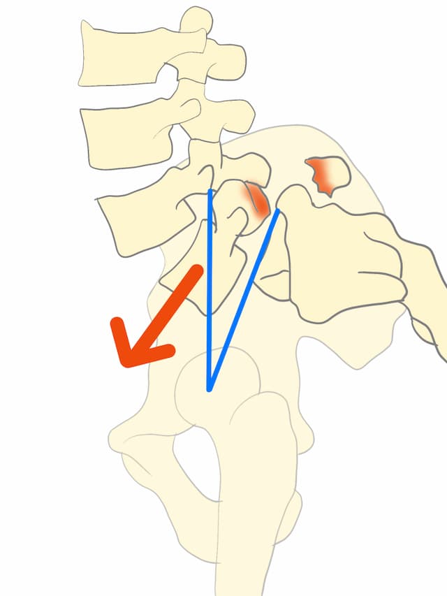 腰椎すべり症と腰椎過前弯の関係