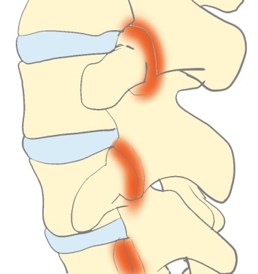 椎間関節の捻挫