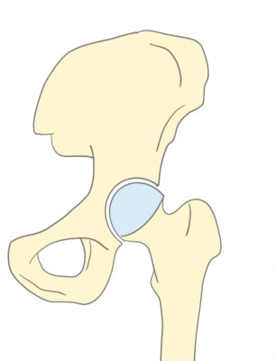 変形性股関節症正常の股関節画像