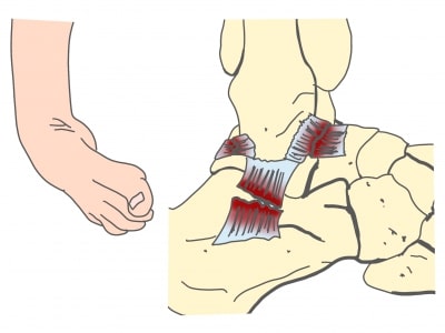 足関節捻挫靭帯損傷