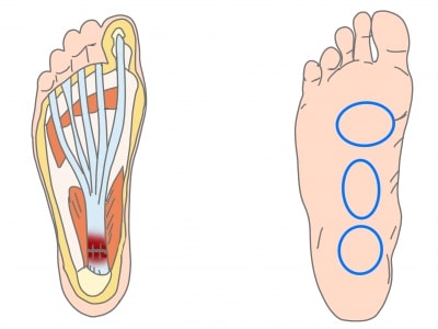 足底腱膜炎痛みの部位