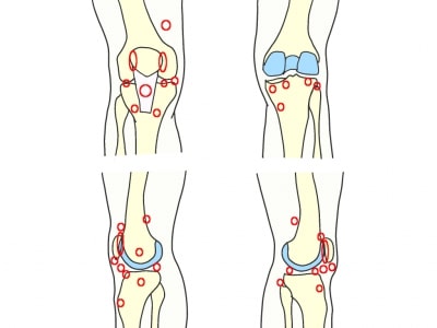 膝関節の圧痛