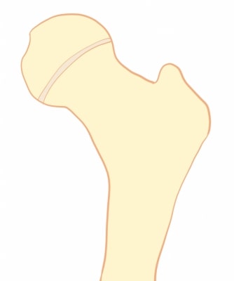 大腿骨の成長線