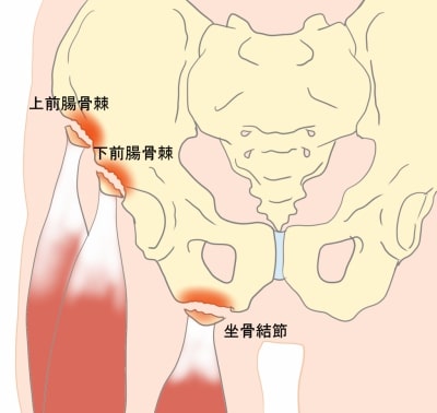 骨盤の裂離骨折坐骨結節の裂離骨折上前腸骨棘の裂離骨折下前腸骨棘の裂離骨折