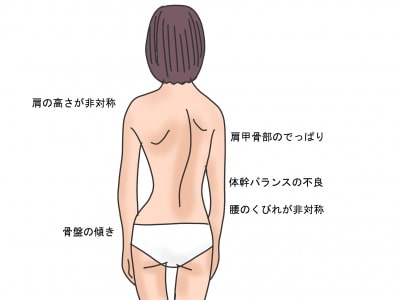 脊柱側弯症の特徴