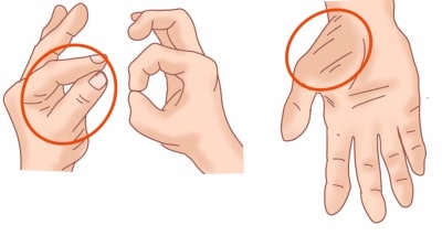パーフェクトOテスト、母指内転筋の萎縮