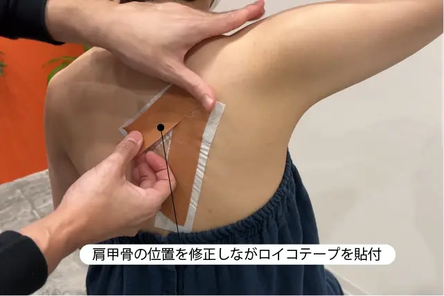 肩甲骨の位置修正テーピング
