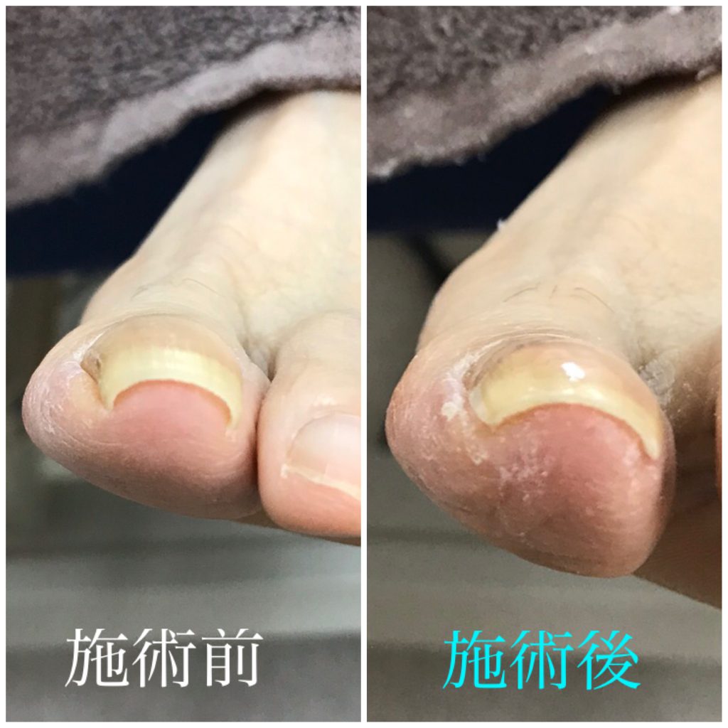 初回の巻き爪補正前後