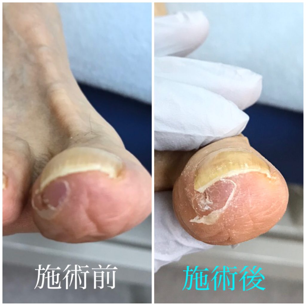 初回の巻き爪補正前後