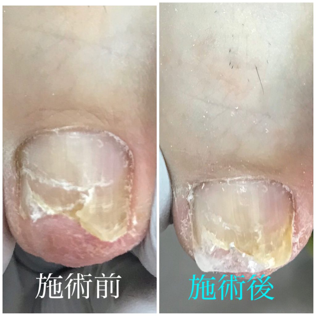 初回の巻き爪補正前後
