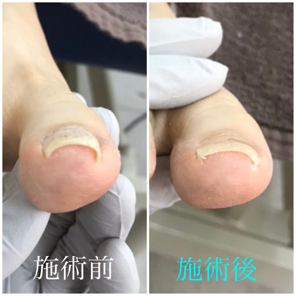 初回の巻き爪補正前後