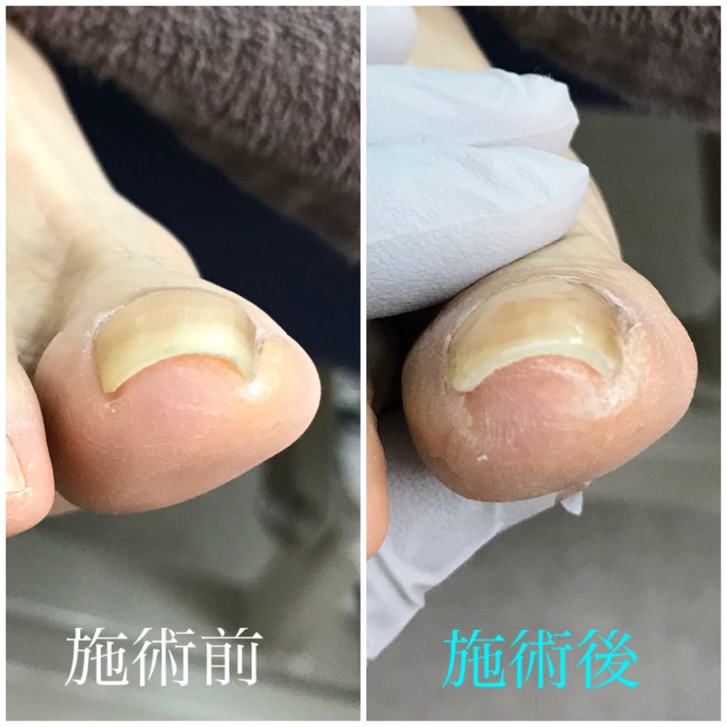 初回の巻き爪補正前後
