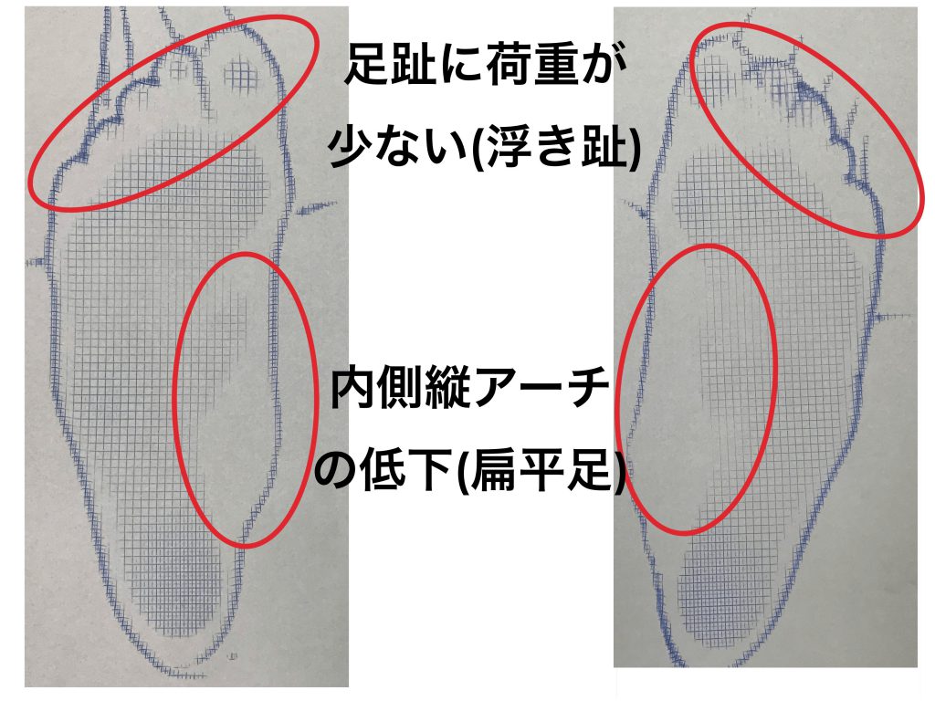 浮き趾と巻き爪の関係