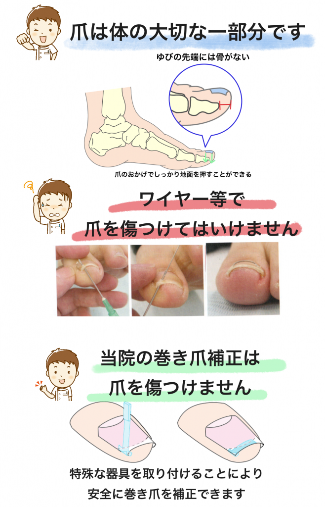 当院の巻き爪補正は爪を傷つけません
