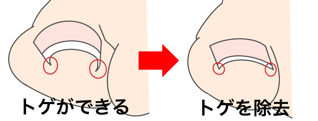 巻き爪トゲ