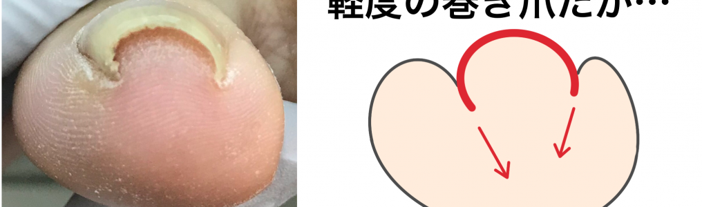 軽度の巻き爪のベクトル
