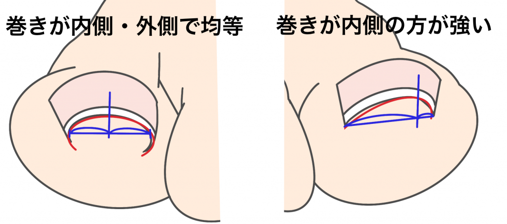 巻き爪金沢